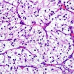 Clear Cell Slide Photo