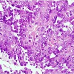 Papillary Cell High Slide Photo
