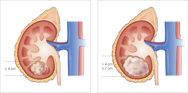 A Study On Renal Cancer